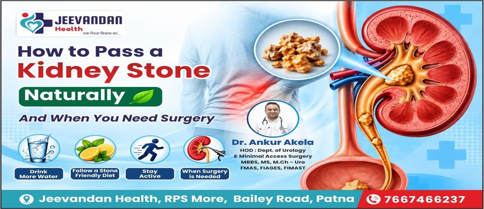 How to Pass a Kidney Stone Naturally (And When You Need Surgery) | Consult Top Urologist