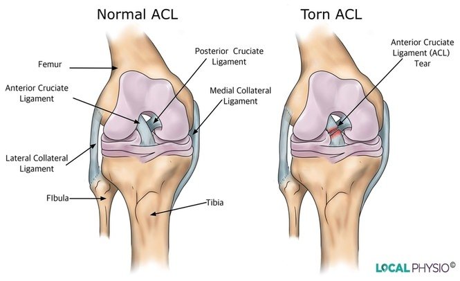 What is an ACL tear?